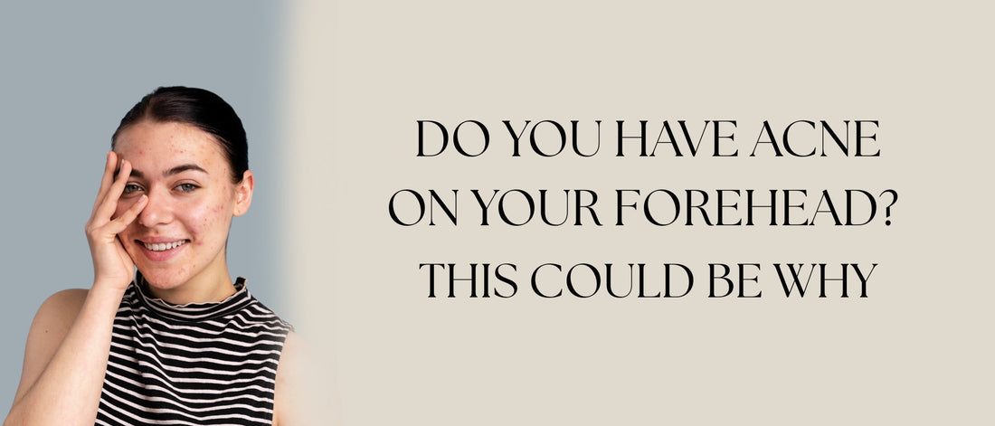 Do You Have Acne on Your Forehead? This Could Be Why