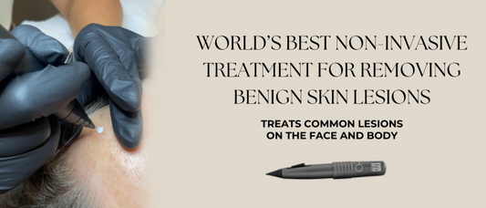 FreezPen Cryotherapy: The Ultimate Solution for Safe, Scar-Free Skin Lesion Removal