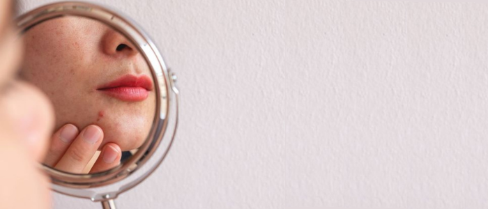How Stress Shows Up On Your Skin