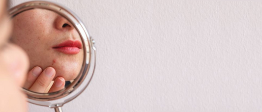 How Stress Shows Up On Your Skin