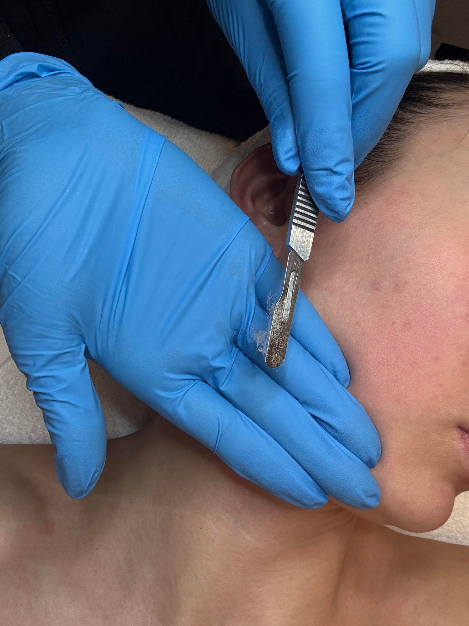 Dermaplaning