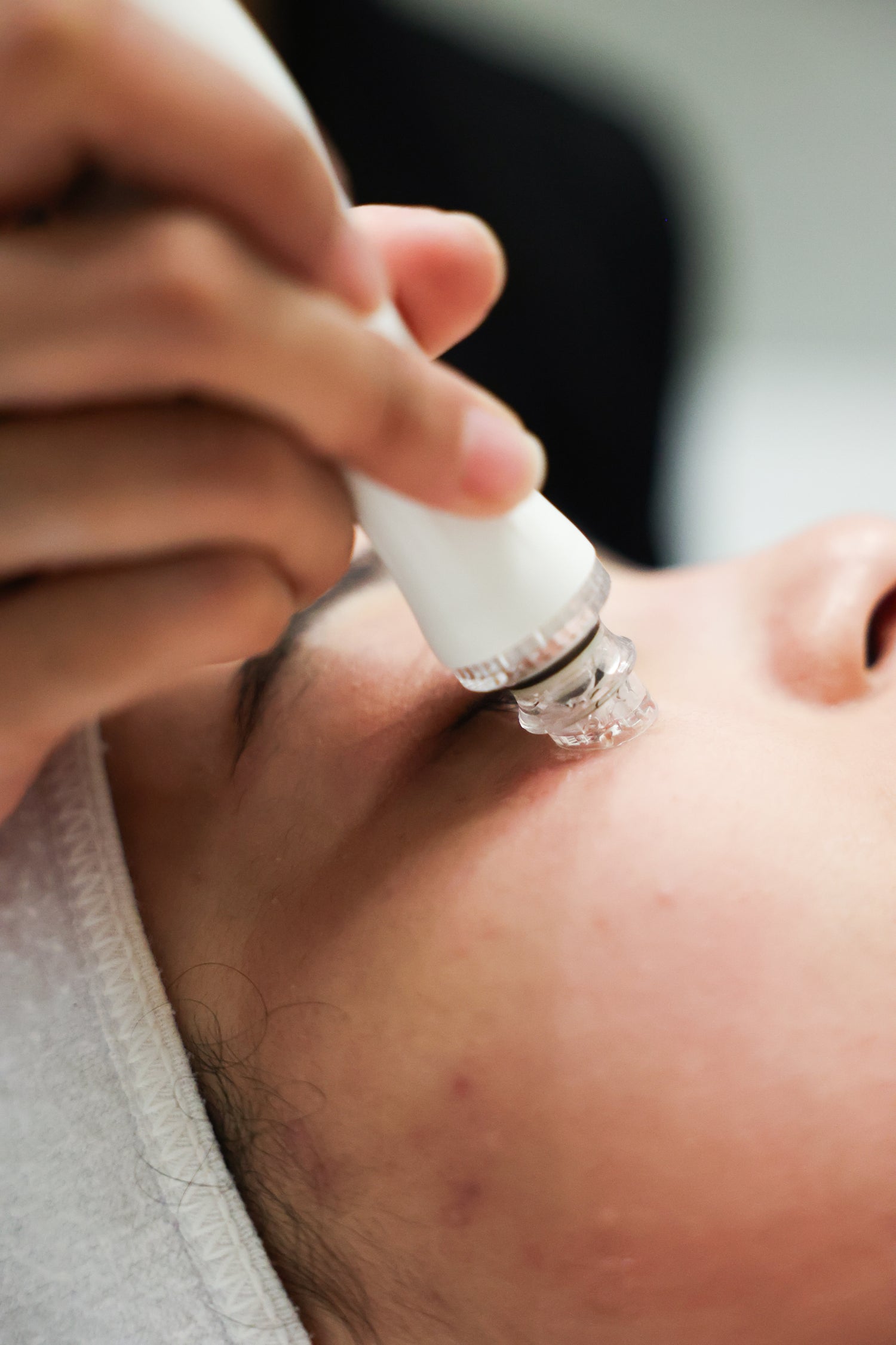 MICRONEEDLING