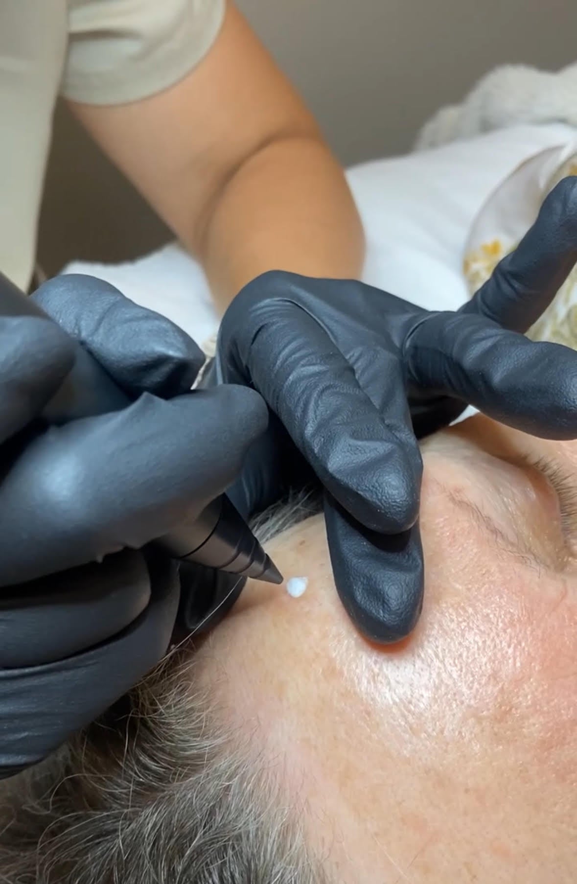 FreezPen Cryotherapy treatment