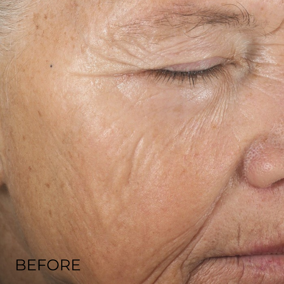 InterFuse Intensive Treatment  LINES