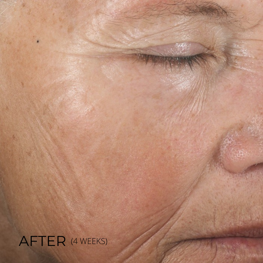 InterFuse Intensive Treatment LINES