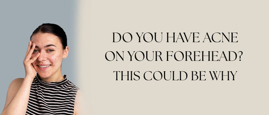 Do You Have Acne on Your Forehead? This Could Be Why