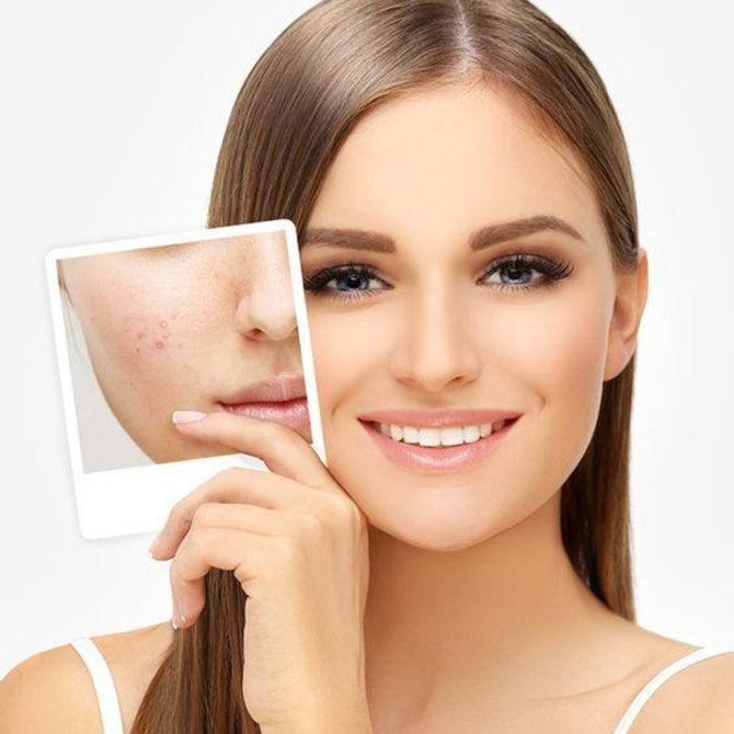 The top 4 proven skin treatments that remove acne and acne scars
